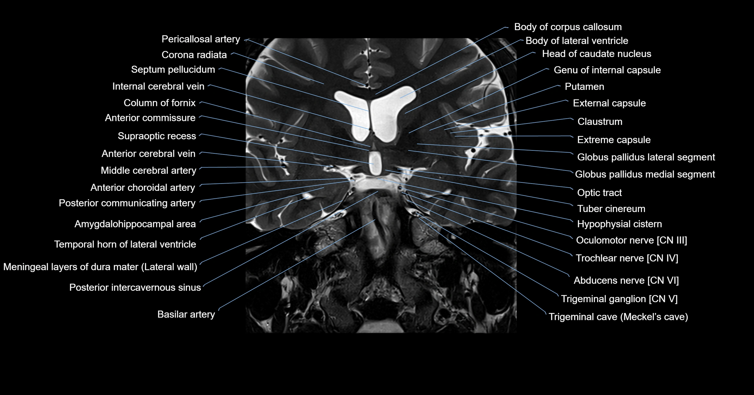 MRI brainstem & basal ganglia anatomy labelled 3T MRI images -img-00001-00015.webp